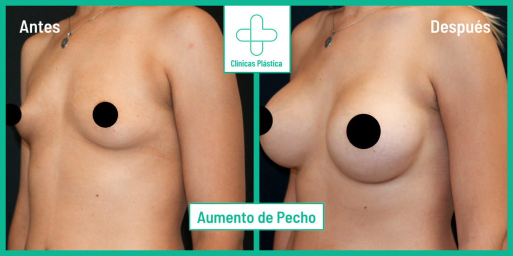 Aumento de Pecho1